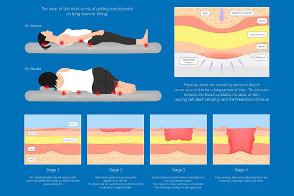 Pressure Prevention