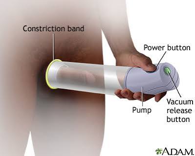 Impotence Device