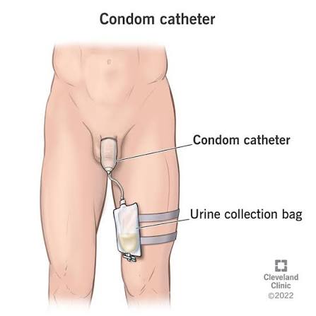 Texas Catheter