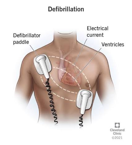 Defibrillation
